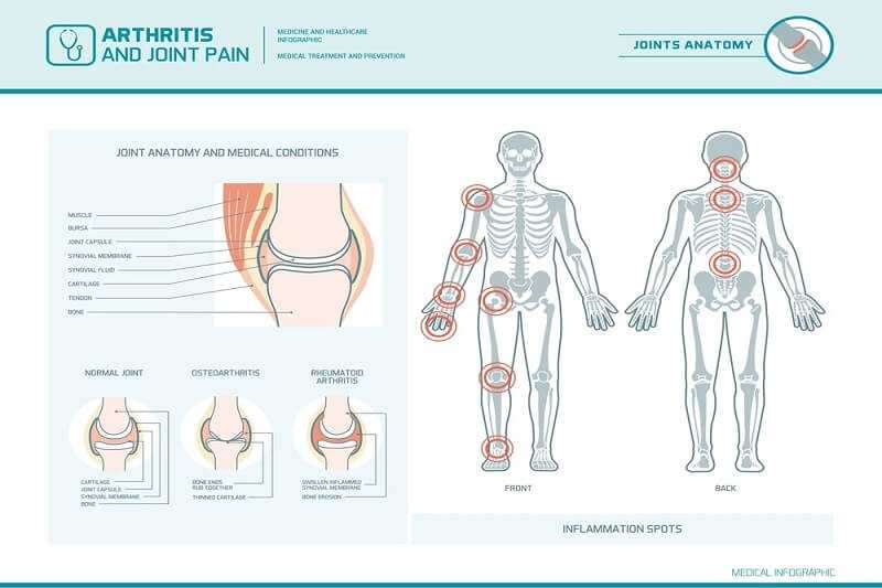 Degenerative Arthritis and pain