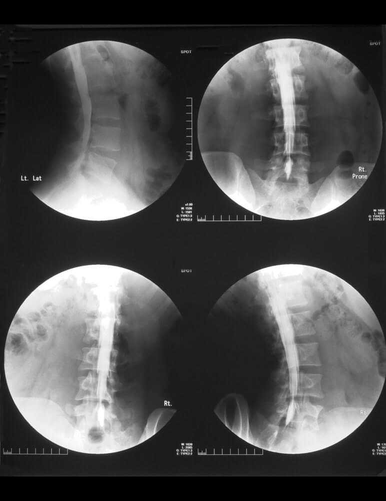 Film myelography spot at lower LS spines