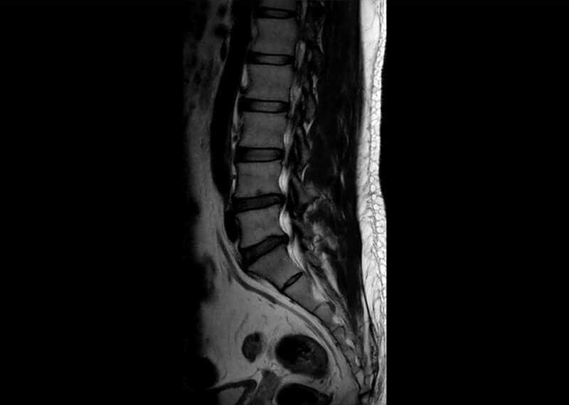 Herniated disc at spine make me very painful