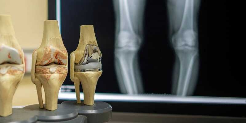 The model of knee joint shown the process of osteoarthritis of knee and total knee replacement surgery