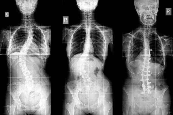 X-ray test for scoliosis