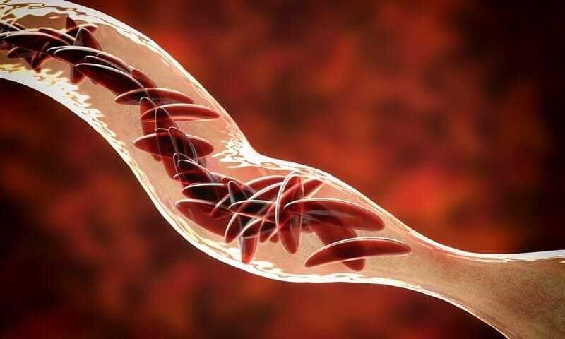 Clumps of sickle cell block the blood vessel