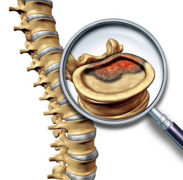Spine cancer and spinal tumor disease medical concept as skeletal vertebra with a magnifying glass close up of a vertabrate with a cancerous growth