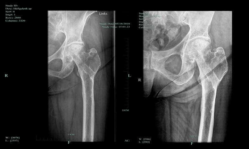 Necrosis of the femoral head and progress of the healing process of greater trochanter fracture