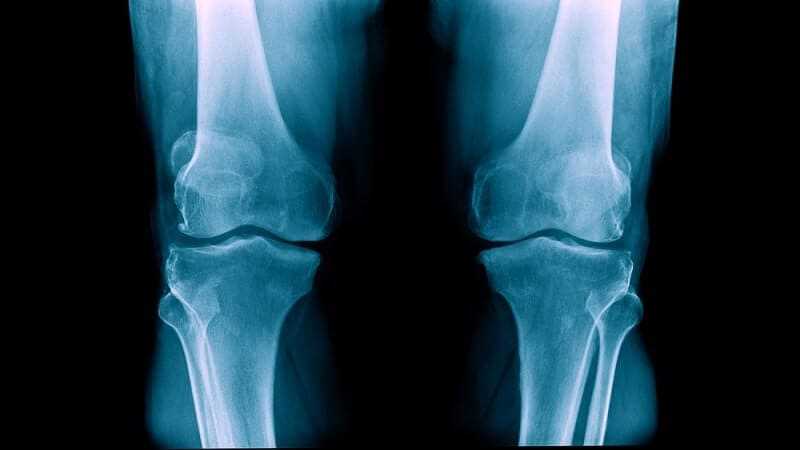 degenerative arthritis says that this is also known as osteoarthritis