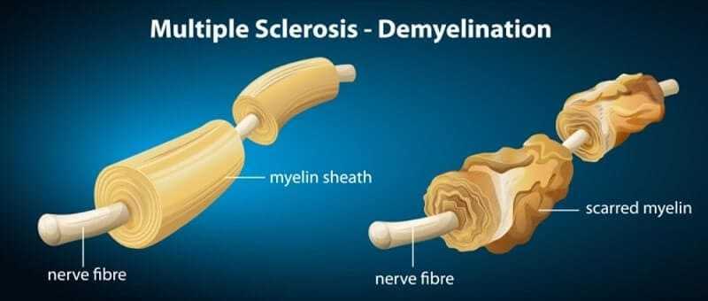 showing the multiple sclerosis