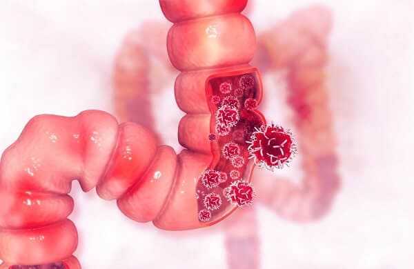 Colon cancer and crohn's disease