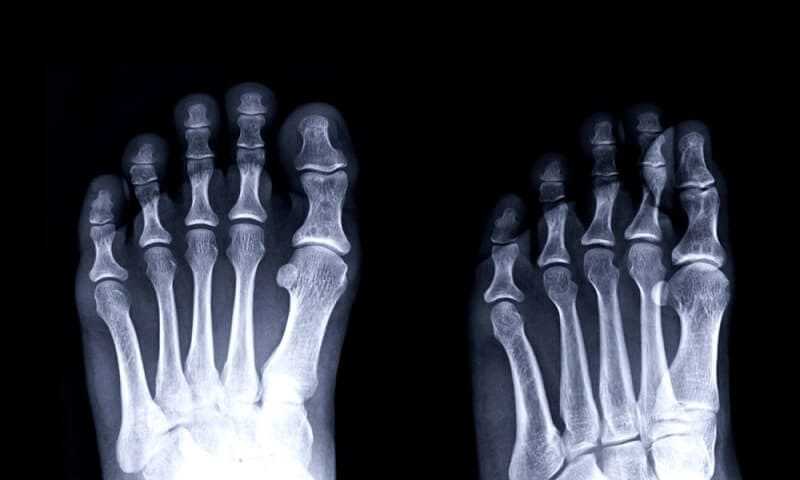 Gouty arthritis film x-ray