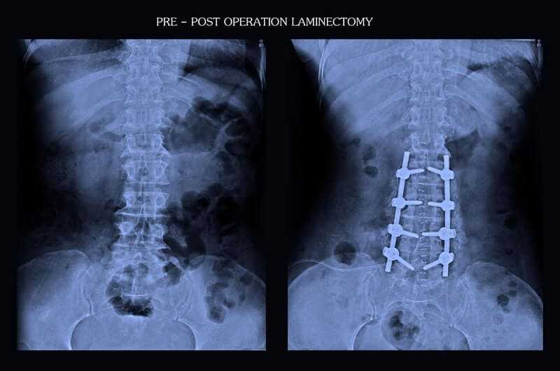 Laminectomy for a Herniated disc