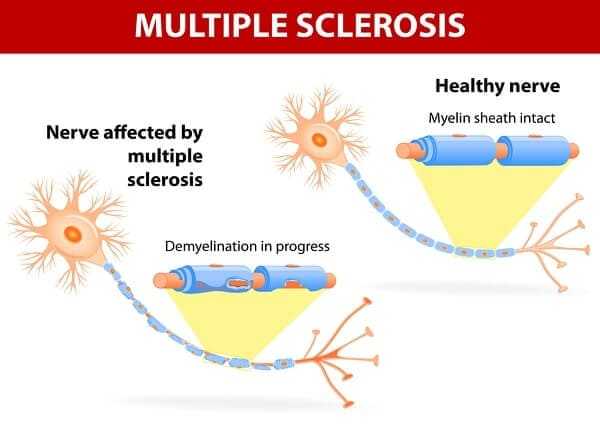 Multiple sclerosis is a specific immune system malfunction