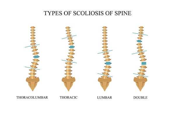 Types of scoliosis of spine