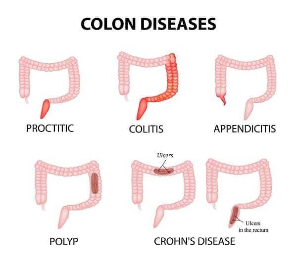 colon diseases