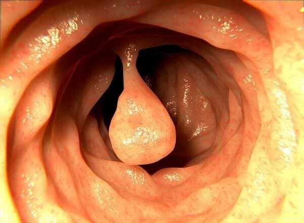 intestinal blockage