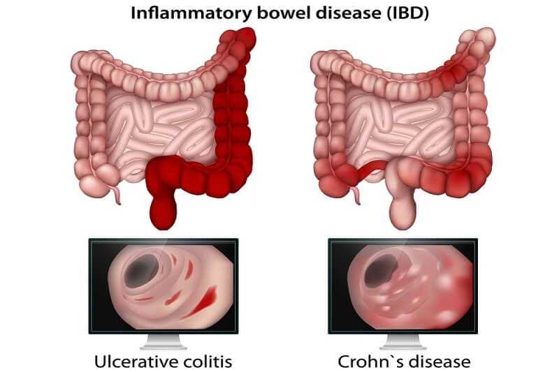 ulcerative colitis (UC) and Crohn’s disease (CD)
