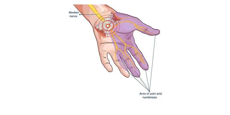 About Carpal Tunnel