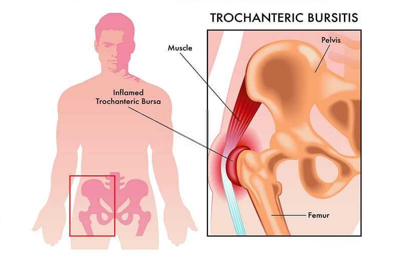 What is Trochanteric Bursitis