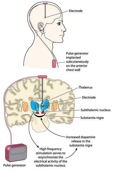 Deep brain stimulation using an implanted pulse generator