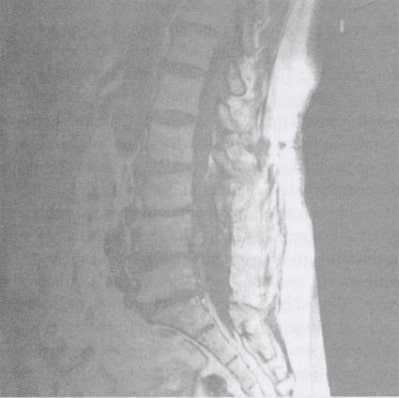 MRI film demonstrating lumbar degenerative disc changes