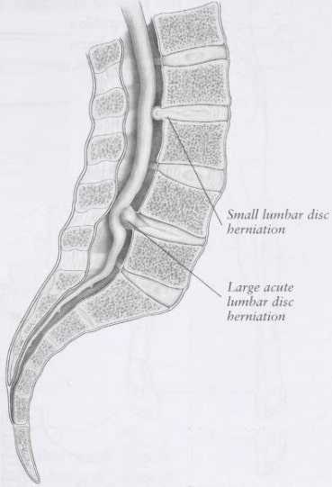 Side view illustration of a small lumbar disc herniation and a large lumbar disc herniation