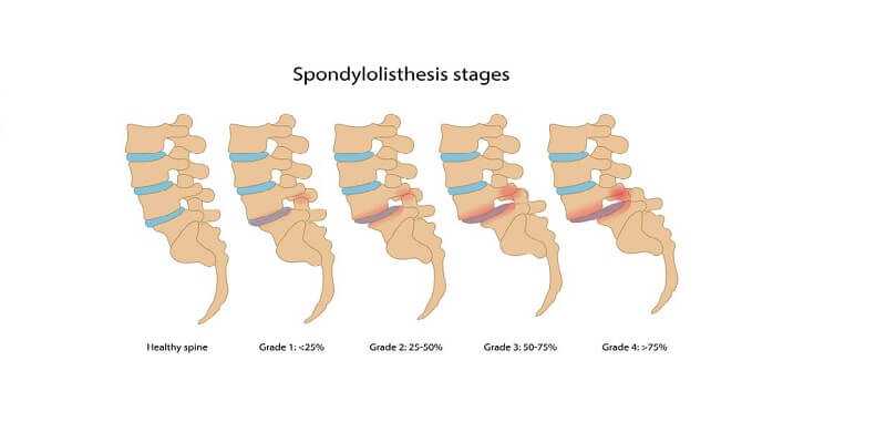 Spondylolisthesis stages