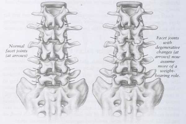 back view of normal and degenerative facet joints