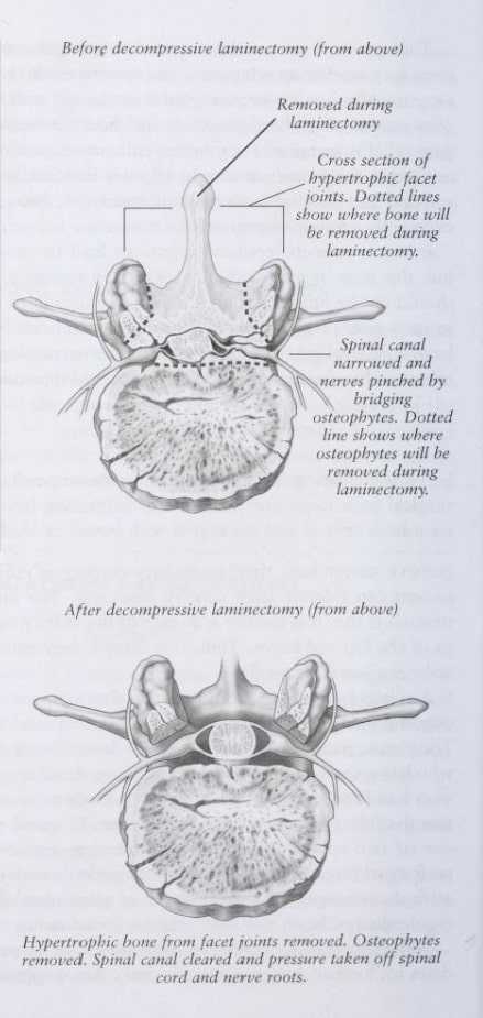 lumbar stenosis changes before and after a laminectomy