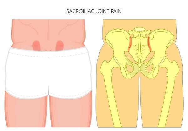 sacroiliac pain