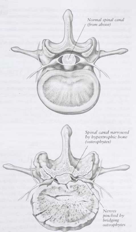 spinal canal changes in lumbar stenosis