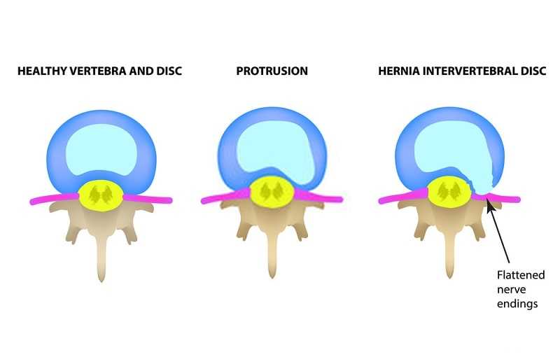 Protrusion of the intervertebral disc and Hernia
