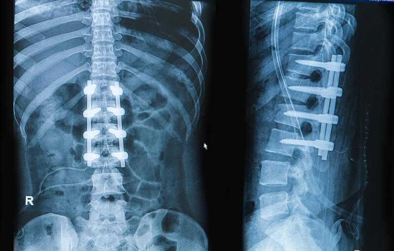 Spinal Fusion for Degenerative Disc Disease