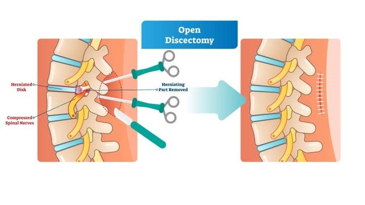 open discectomy