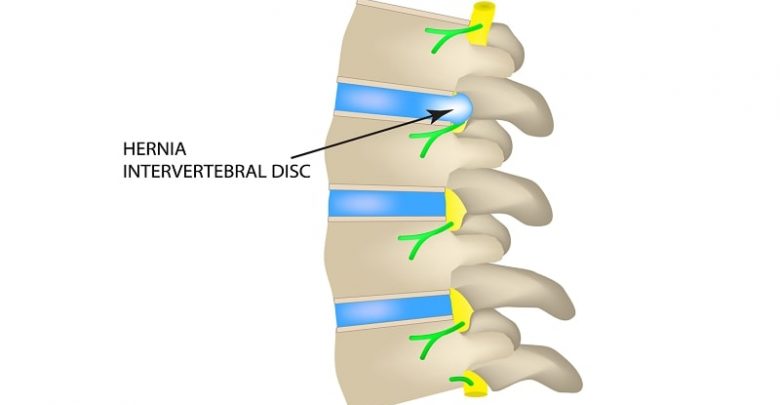 Acute Intervertebral Disc Herniation