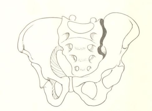 An inner view of the left sacroiliac joint. If the joint on one side of the sacrum is in poor alignment, the other side must be too.