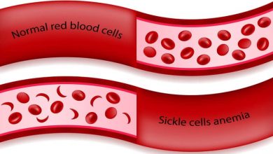 Comparison between normal red blood cells and sickle cells anemia in blood vessel