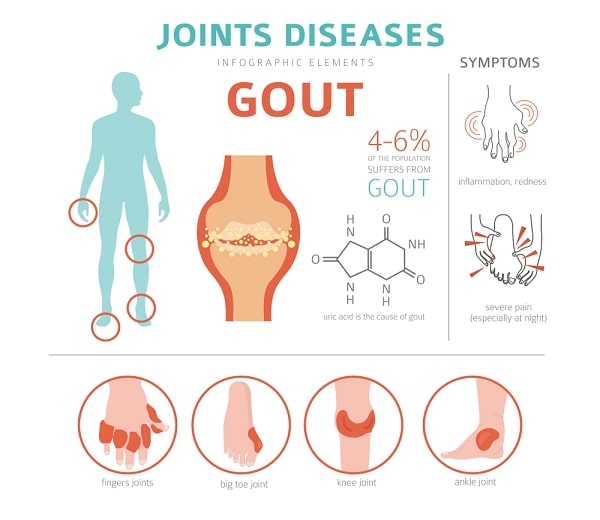 Gout symptoms and treatment