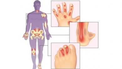 anatomy effected by psoriatic arthritis