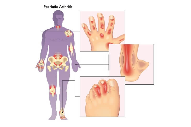 anatomy effected by psoriatic arthritis