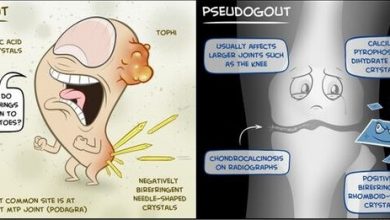 gout and pseudogout