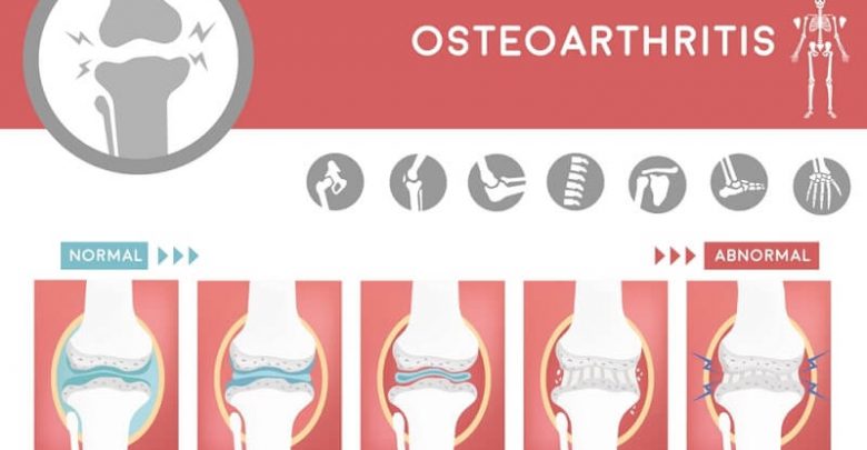 degenerative of osteoarthritis