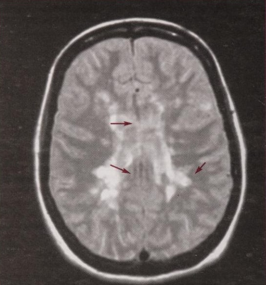 A typical T2 - weighted brain MRI in MS.