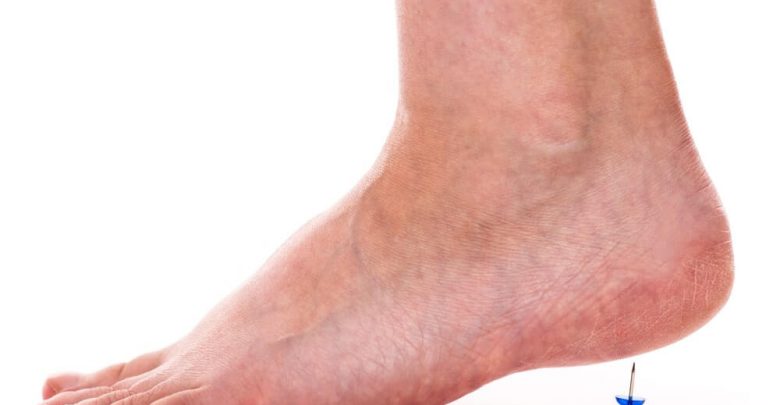 Can Plantar Fasciitis be Completely Cured