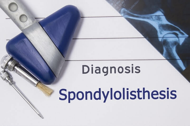 where is printed diagnosis Spondylolisthesis