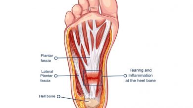 How to manage Plantar Fasciitis