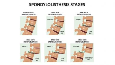 Healthy spine and spine with spondylolisthesis