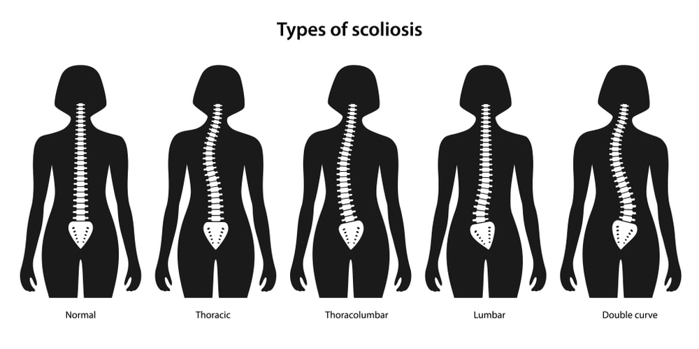 Anterior Thoracolumbar Surgery for Scoliosis