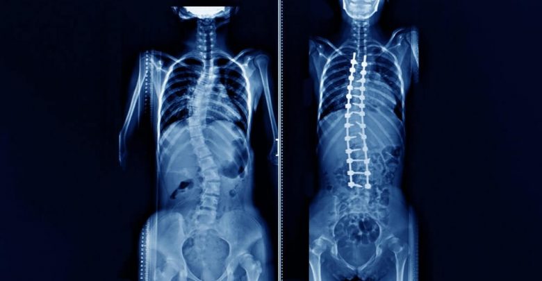 Back Surgery for Scoliosis