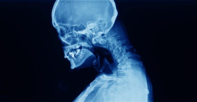 Cervical spine x-ray showing spondylosis