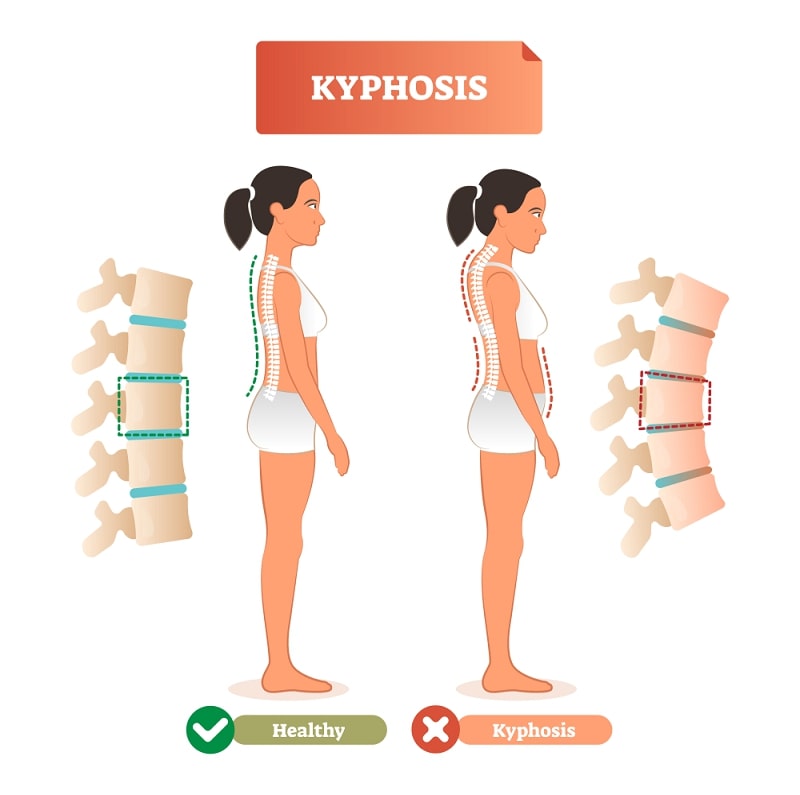 Kyphosis vector illustration