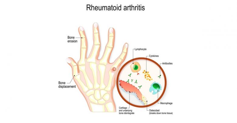 hand with rheumatoid arthritis and typical joint swelling