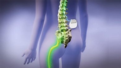 Spinal Cord Stimulation Trials Fail to Convince Patients